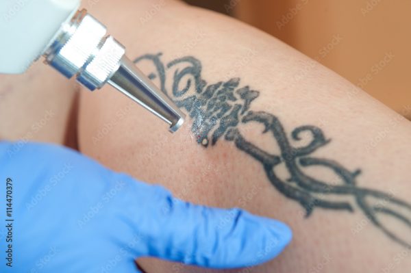 Laser Tattoo Removal