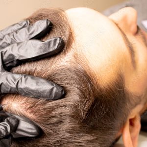Scalp Micropigmentation