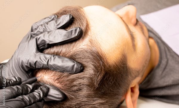 Scalp Micropigmentation